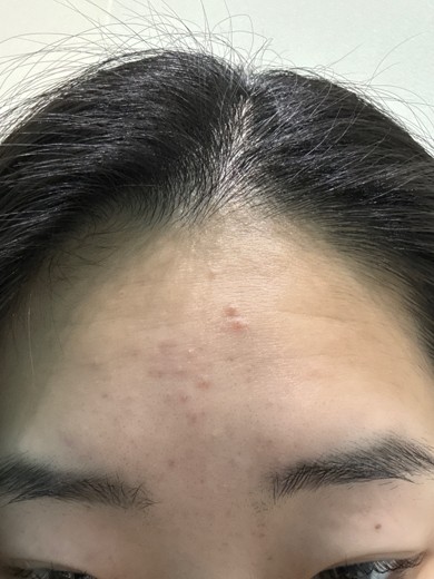 before photo: ダーマペン