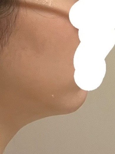 after photo: 脂肪吸引(顎下)