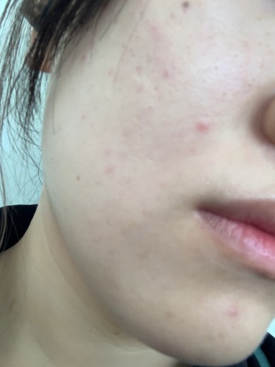 after photo: 脱毛(顔)