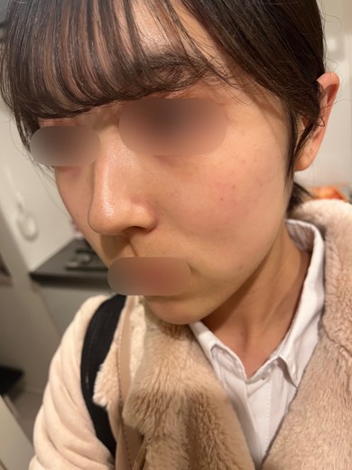 after photo: マッサージピール(コラーゲンピール)