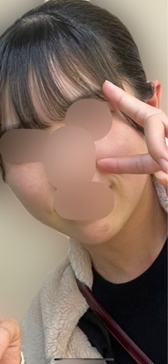 before photo: マッサージピール(コラーゲンピール)