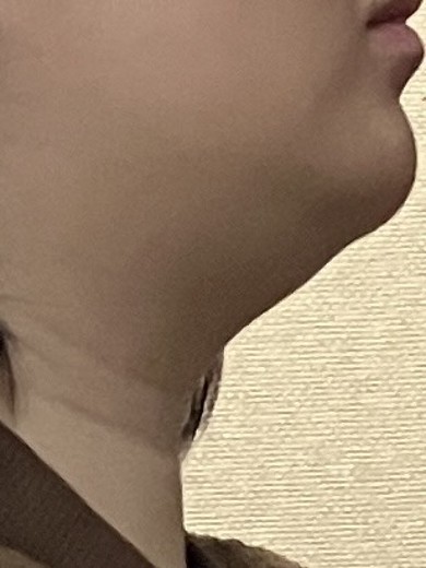 before photo: 인모드리프팅