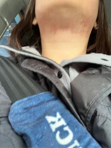 after photo: 인모드리프팅