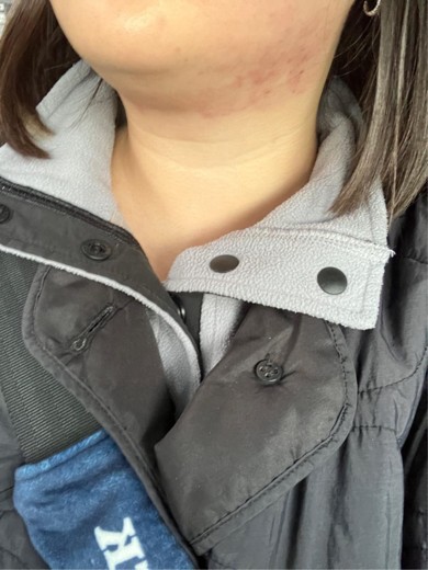 after photo: 인모드리프팅