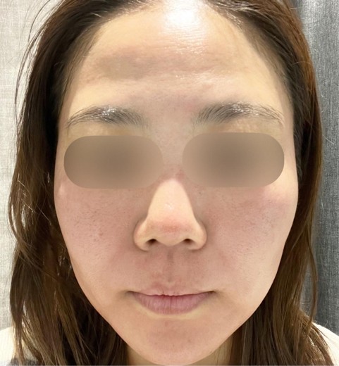 after photo: ダーマペン, 診断・検査, PRP皮膚再生療法