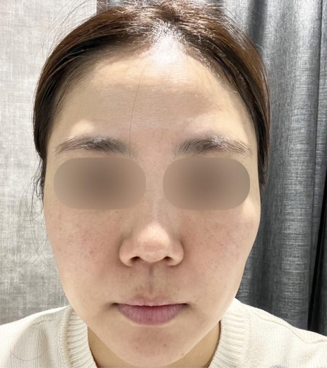 before photo: ダーマペン, 診断・検査, PRP皮膚再生療法