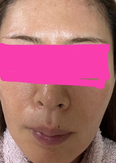 after photo: PRP皮膚再生療法