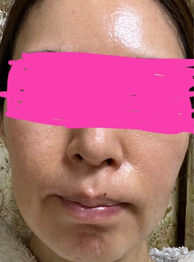 before photo: PRP皮膚再生療法