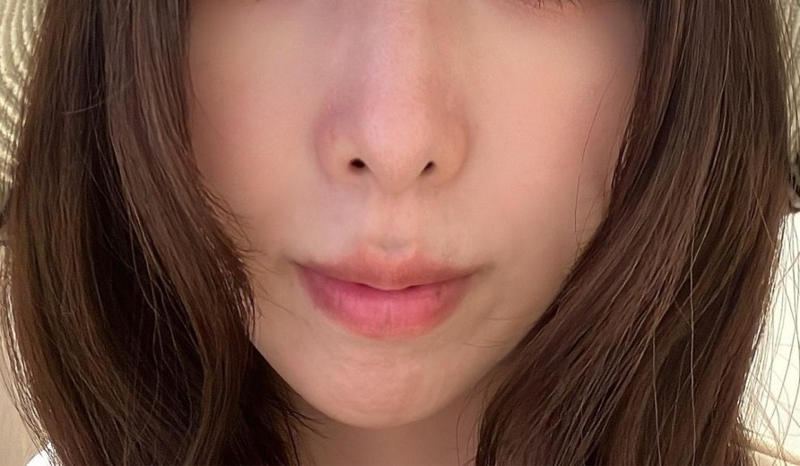 before photo: ほうれい線ヒアルロン酸
