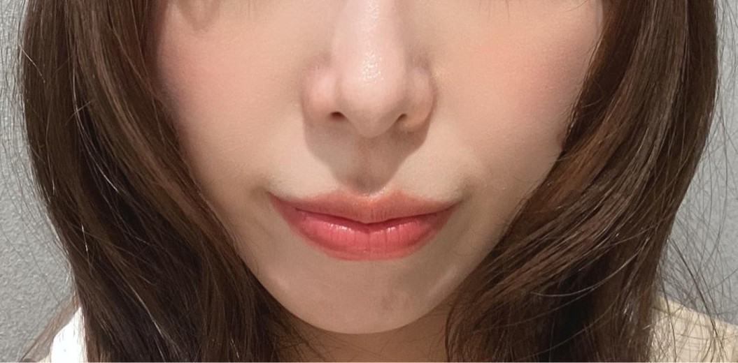 before photo: ほうれい線ヒアルロン酸