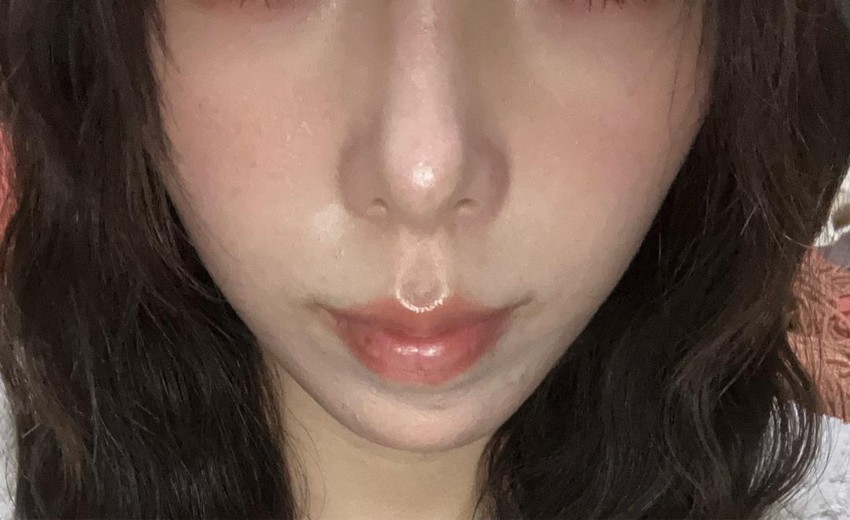 after photo: ほうれい線ヒアルロン酸