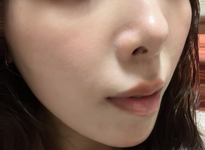 after photo: ほうれい線ヒアルロン酸