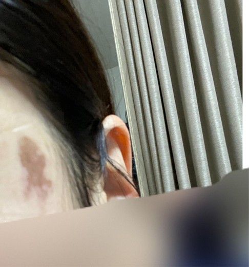 before photo: Qスイッチレーザー