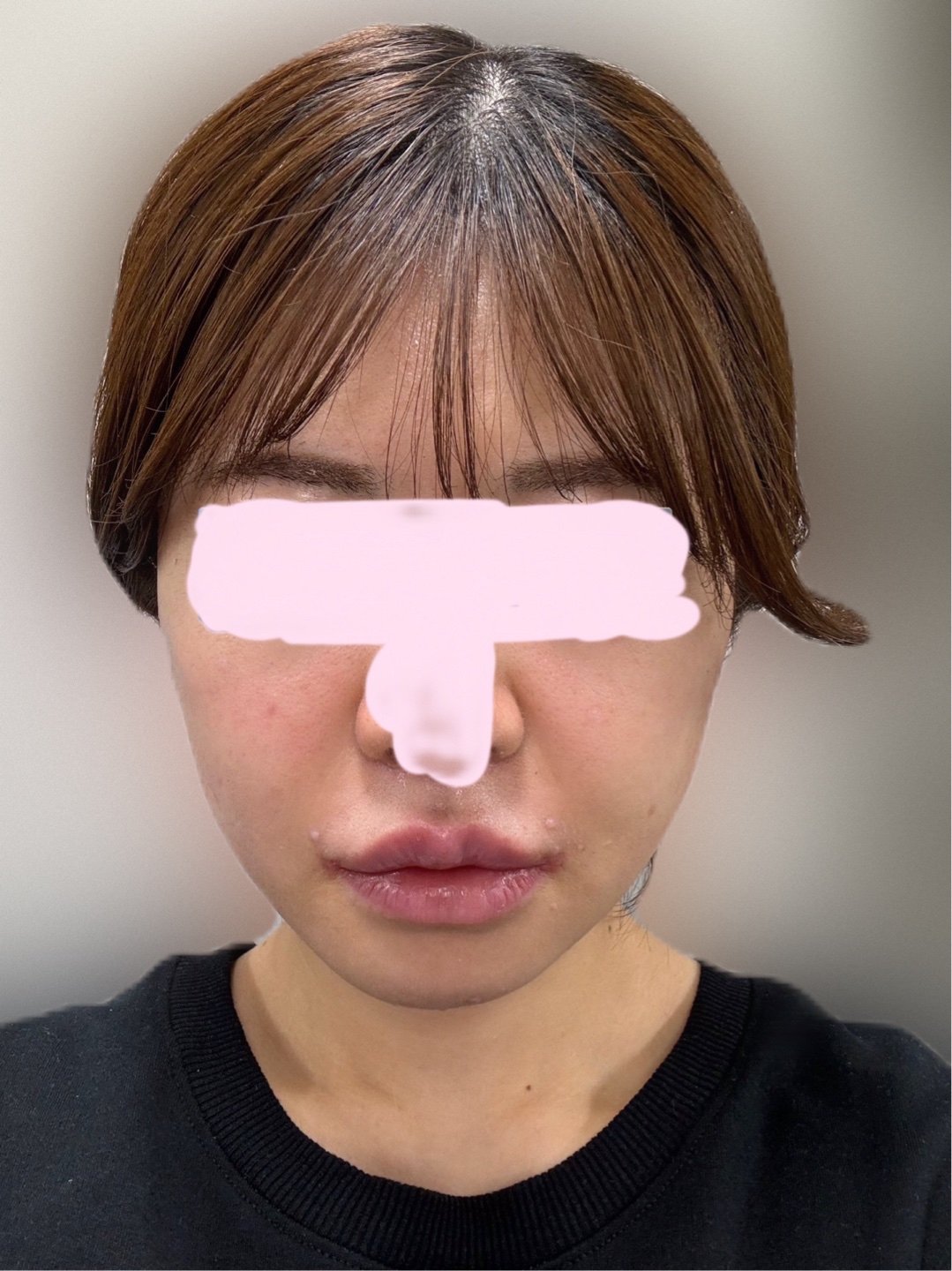 Deep Plane SMAS Facelift