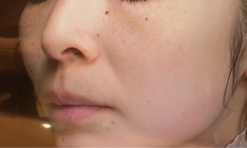 before photo: IPL(光/フォト治療), 診断・検査