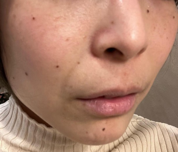 after photo: IPL(光/フォト治療), 診断・検査