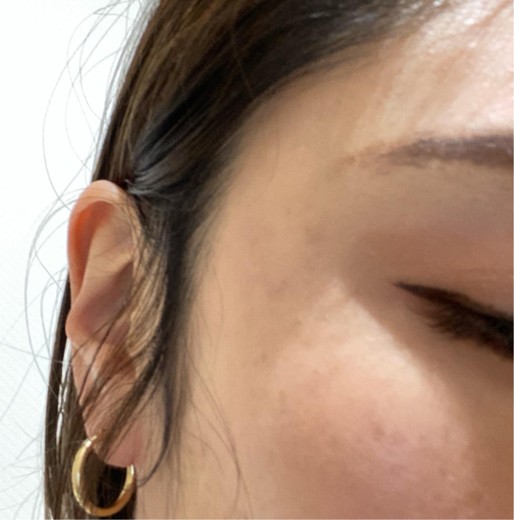 after photo: Qスイッチレーザー