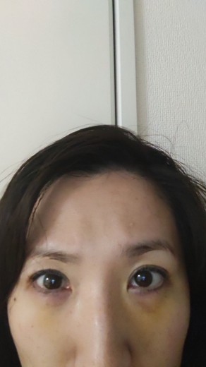 after photo: 脱脂(クマ治療)