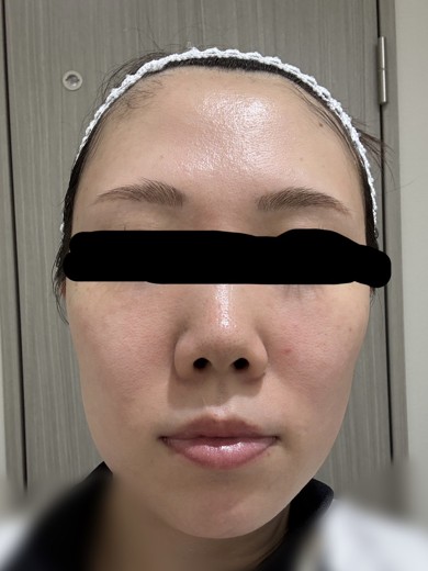 before photo: 水光注射
