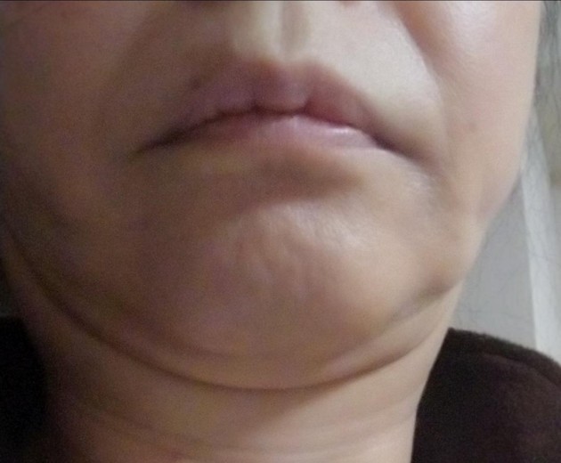 after photo: ハイフ(HIFU)