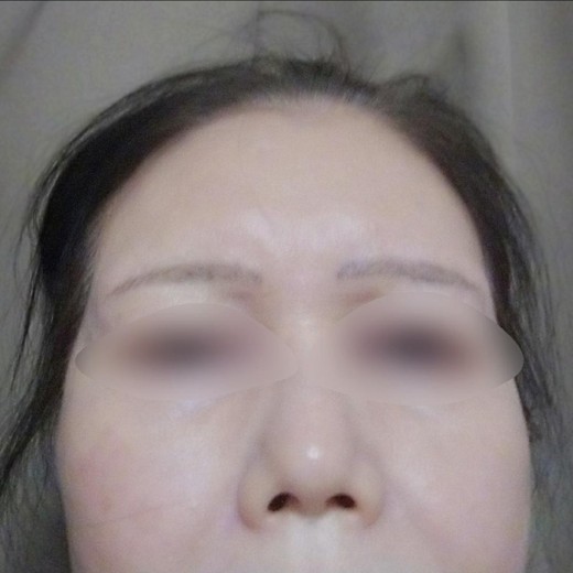 after photo: ハイフ(HIFU)