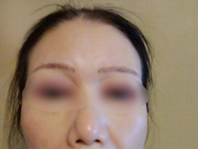 before photo: ハイフ(HIFU)