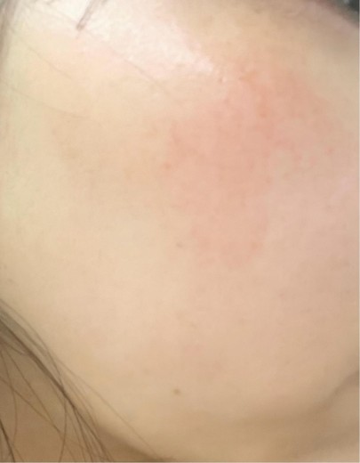 before photo: IPL(光/フォト治療)