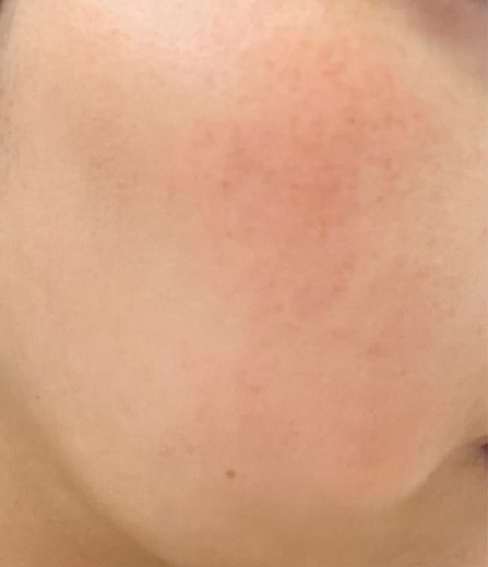 after photo: IPL(光/フォト治療)