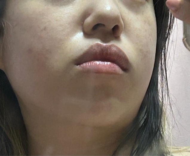 after photo: IPL(光/フォト治療), 診断・検査