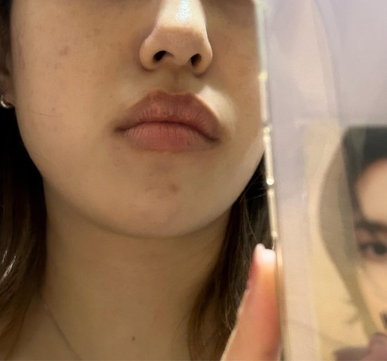 before photo: IPL(光/フォト治療), 診断・検査