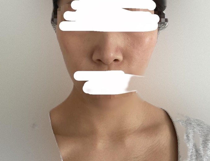after photo: エレクトロポレーション