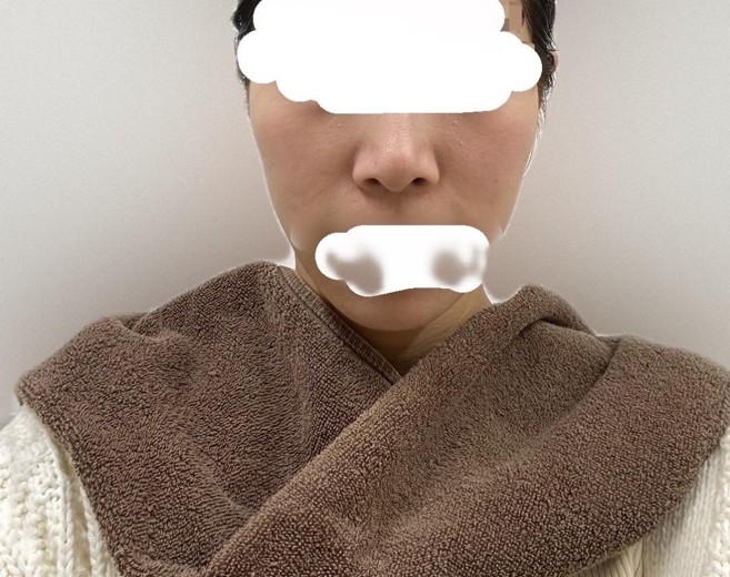 before photo: エレクトロポレーション