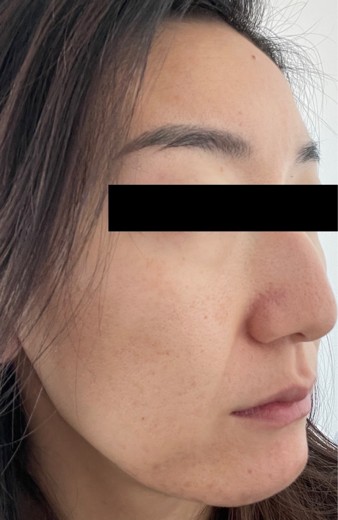 before photo: 糸リフト