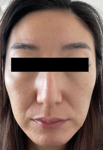 before photo: 糸リフト