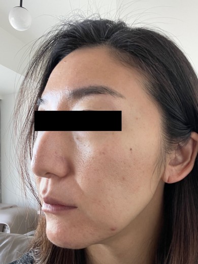 before photo: 糸リフト
