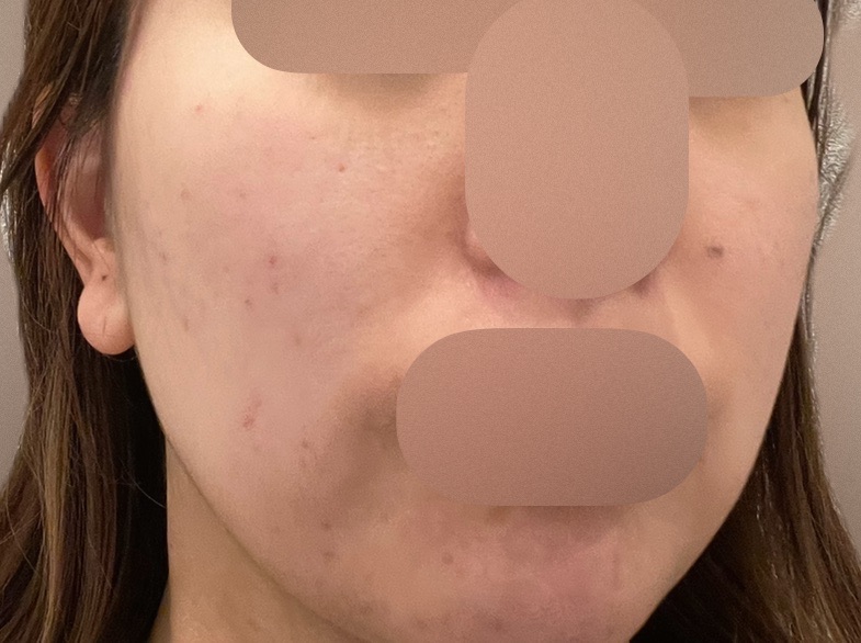 GSD フォトフェイシャル シミ・肝斑治療✨ フォトフェイシャル（ステラM22）2回＋ エレクトロポ