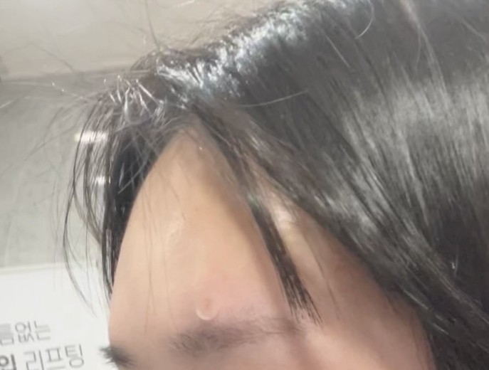 after photo: 이마필러