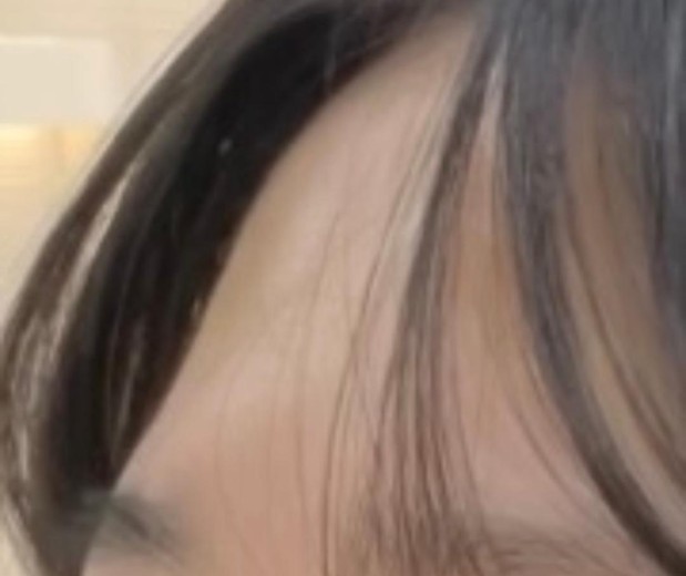 before photo: 이마필러