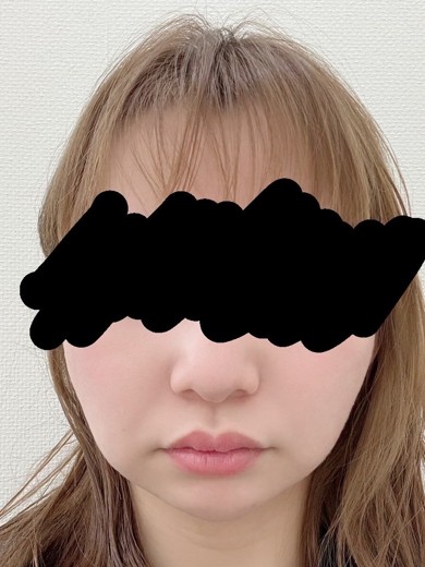 before photo: 糸リフト, 脂肪吸引(顔)