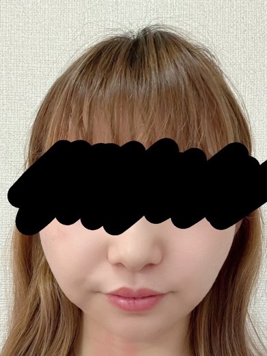 after photo: 糸リフト, 脂肪吸引(顔)