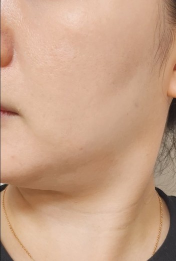 before photo: 인모드리프팅