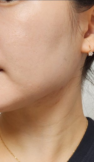 after photo: 인모드리프팅