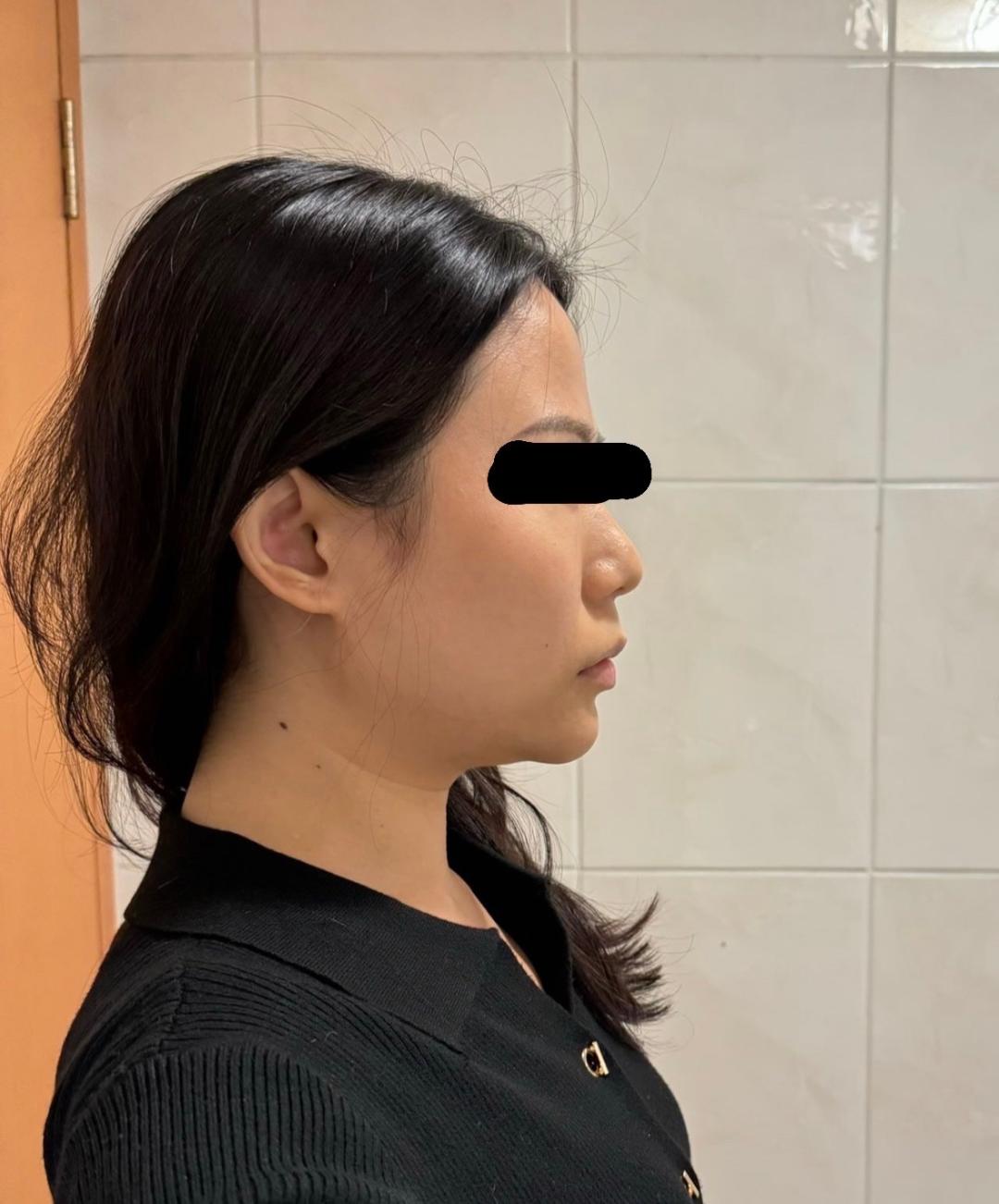 Kybella
