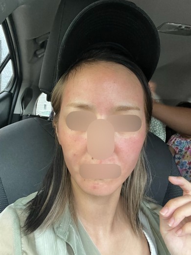 after photo: ダーマペン