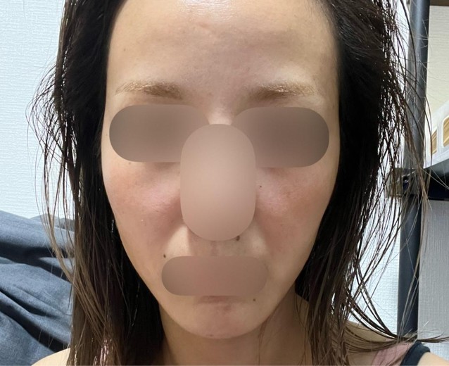 before photo: ダーマペン