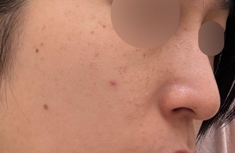 before photo: IPL(光/フォト治療), 診断・検査