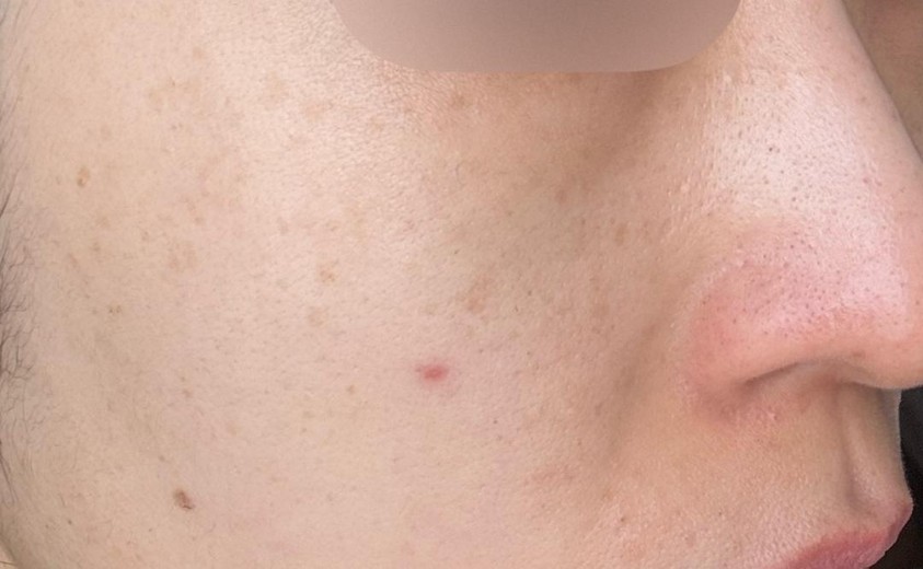 after photo: IPL(光/フォト治療), 診断・検査