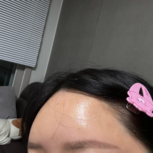 after photo: 이마필러