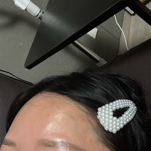 before photo: 이마필러