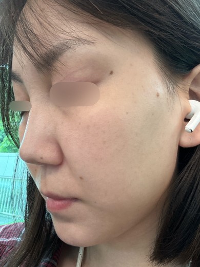 after photo: エレクトロポレーション
